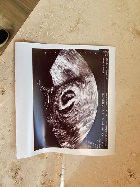 Máte zkušenosti s hematomem kolem dělohy? Jak se léčil?