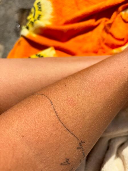 Co způsobuje svědivé vyrážky na těle? Zjistěte více!