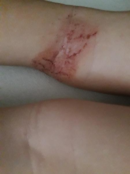 Atopický ekzém. Jak dlouho vysadit mléko, aby se přišlo na to, že je alergenem?