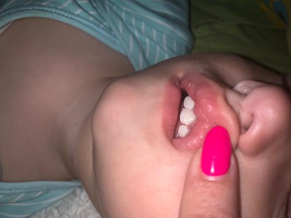 Skvrny u dásní. Jedná se o demineralizaci? Jak řešit?