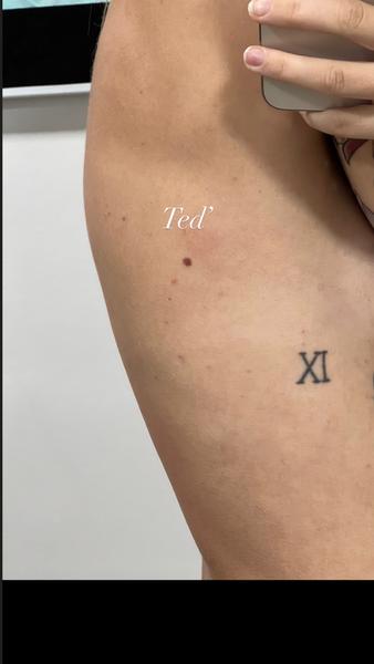 Strach ze změn u znaménka na zádech. Co teď dělat?