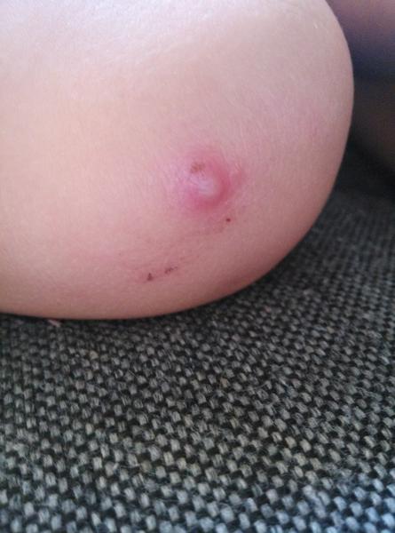 Jít k doktorovi se zanícenou nožkou?