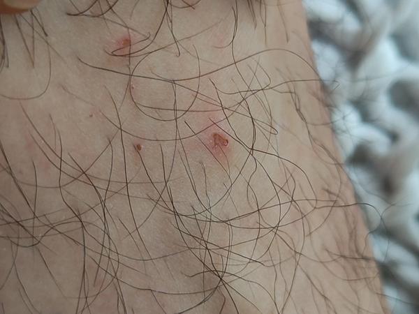 Strupovitá svědivá vyrážka na nohách: svrab nebo kočičí blechy?