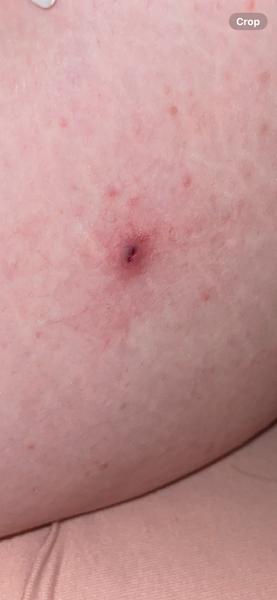 Krvavá boulička na stehně. Co by to mohlo být?