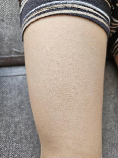 Krupičková vyrážka u dítěte. Mohla by to být alergie?