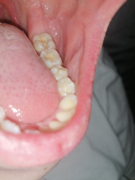 Kaz na zubu, i když jsem byla na kontrole. Je možné, že to pan doktor neviděl?