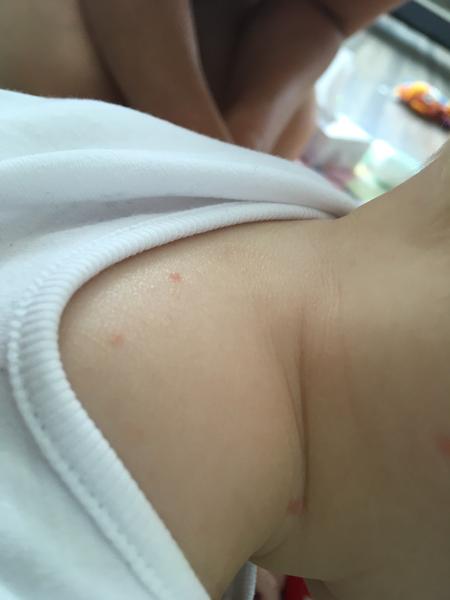 Co by mohly být tyto pupínky?