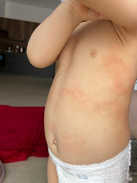 Ekzém nebo alergická reakce u dětí: Kdy volat lékaře?