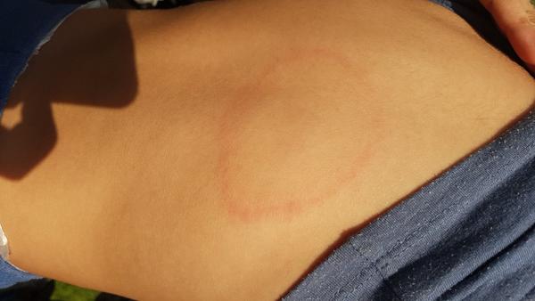 Fleky. Co to může být?