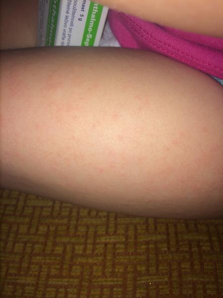 Drobné pupínky - je to plíseň nebo ekzém?