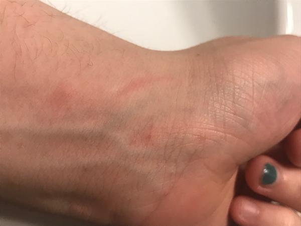 Svědivá kožní vyrážka: Co může být příčinou?