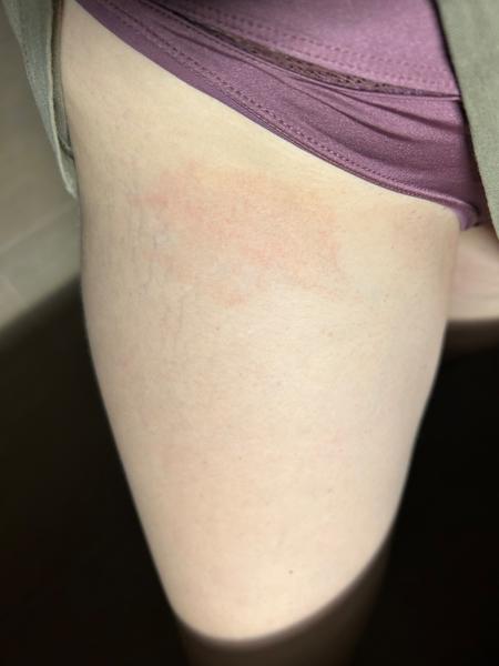 Nevíte, jak řešit kožní problémy po porodu?