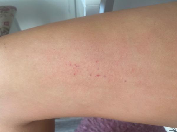 Štípnutí od roztoče nebo jiného parazita během spánku?