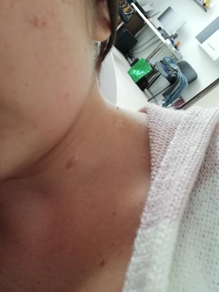 Má těhotenství vliv na zhoršení jizvy na krku?