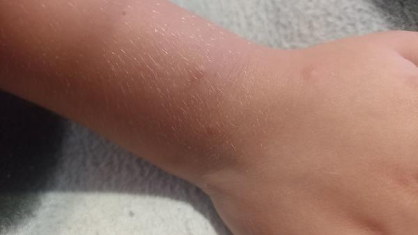 Rozpoznání vyrážky u dětí: Neštovice nebo štípnutí hmyzem?