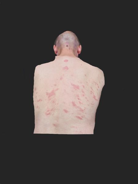 Ekzém. Poradíte, prosím?