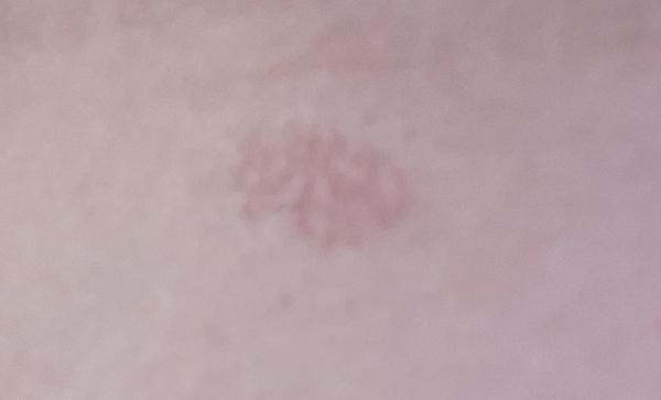 Červený suchý flek na kůži. Může stres ovlivňovat?