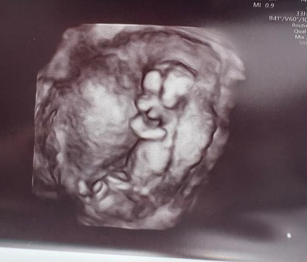 Může foto prvního screeningu odhalit pohlaví miminka?