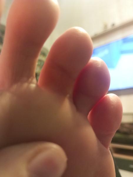 Špatné boty způsobují otok prstů na nohou?