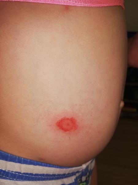 Impetigo - může to být?