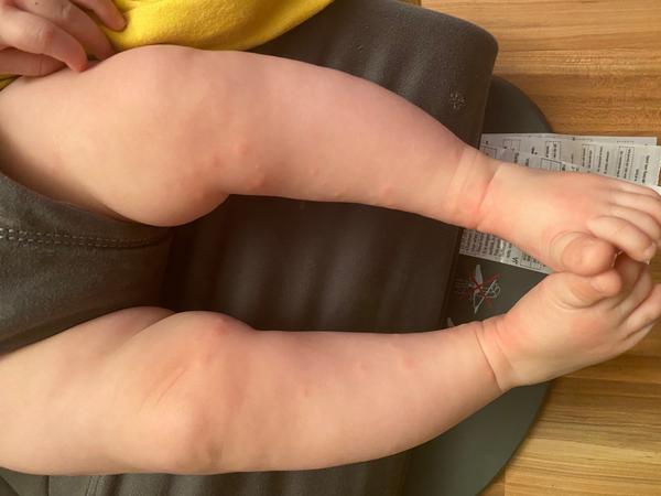 Vyrážka. Co myslíte?