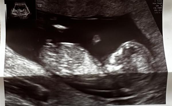 Odhad pohlaví dítěte ve 14. týdnu těhotenství?