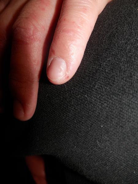 Zvlnění nehtů, může to být po gelových nehtech?