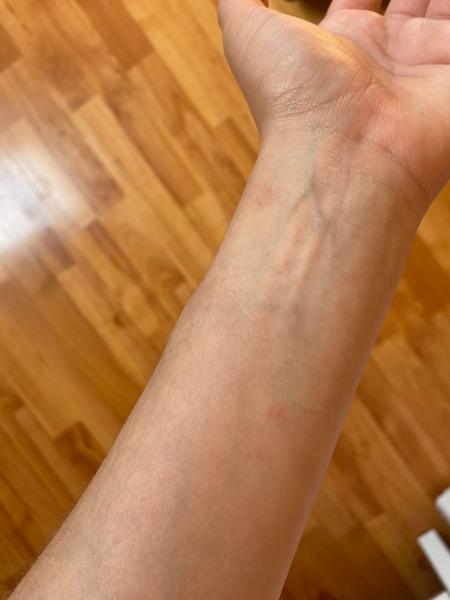 Jak poznat příznaky svrabu a jak předcházet nákaze?