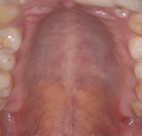 Výrůstky na tvrdém patře. Co to může být?