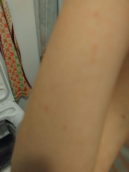 Pupínky na zápěstí. Je to alergie nebo svrab?