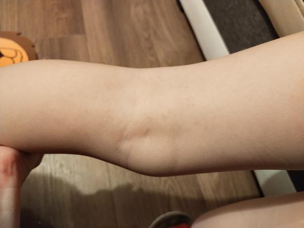 Ekzém a pupínky po těle. Poradíte, prosím?