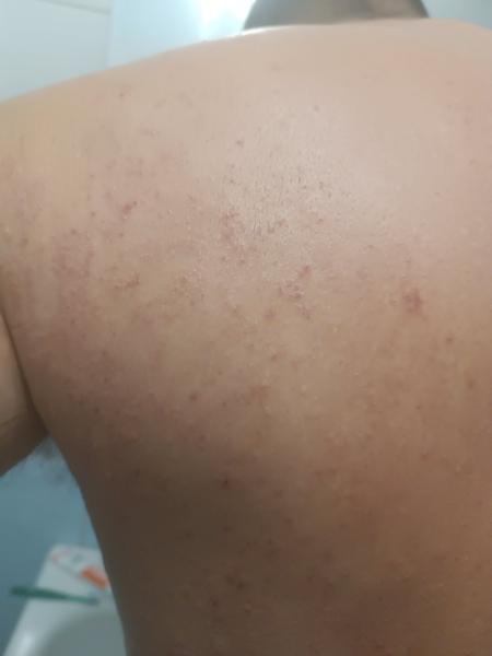 Vyrážka. Máte zkušenost, co by to mohlo být?