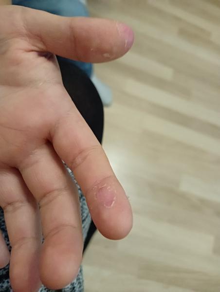 Loupající se bříška prstů u dětí. Jaké jsou příčiny?