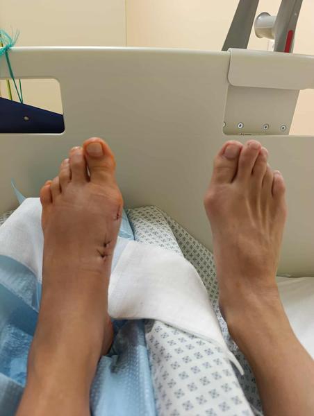 Hallux Valgus - vbočený palec - operace Mica