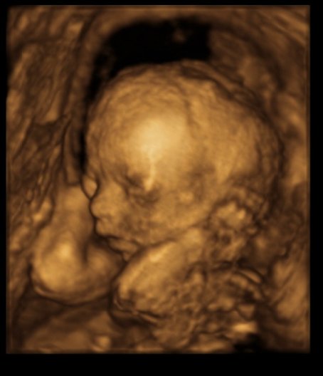 Foto z ultrazvuku 4D/2D 25.tt