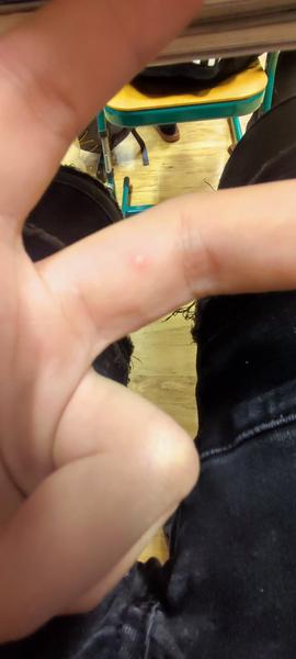 Bolestivé pupínky na ruce. Jaká je možná příčina?