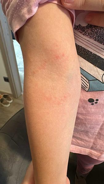 Jak zjistit, zda je vyrážka alergií nebo něčím jiným?