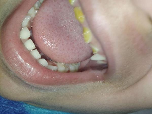 Jak řešit medové zuby u čtyřletého dítěte?