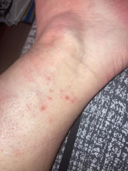 Je svědění nohou během těhotenství příznakem svrabu?