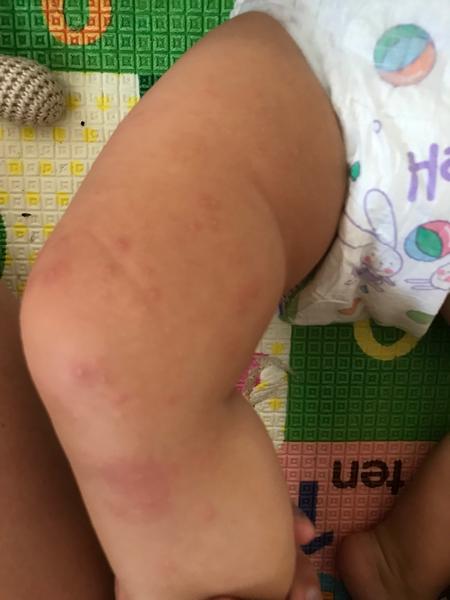 Vyrážka na nozičkách ročního chlapečka. O jakou vyrážku by se mohlo jednat?