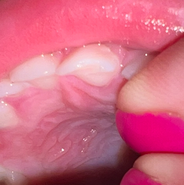 Ulomený mléčný zub u dítěte. Jak řešit?