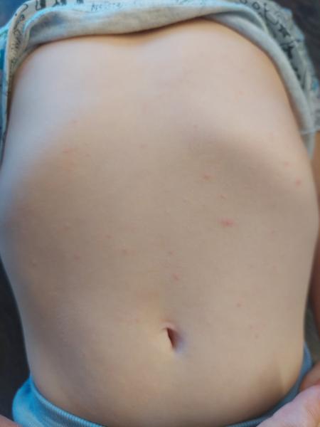 Jsou to příznaky neštovic?