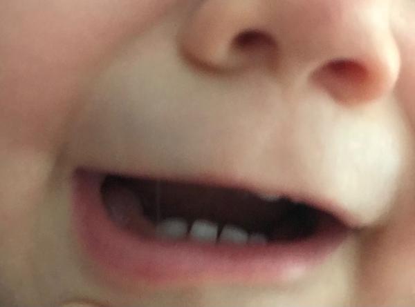 Puchýř na dásni. Co to může být a co s tím?