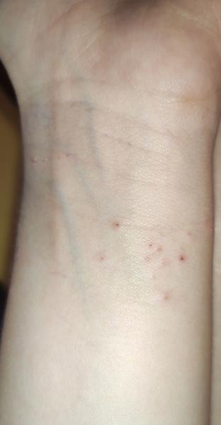 Zahadna vyrážka/ štipance