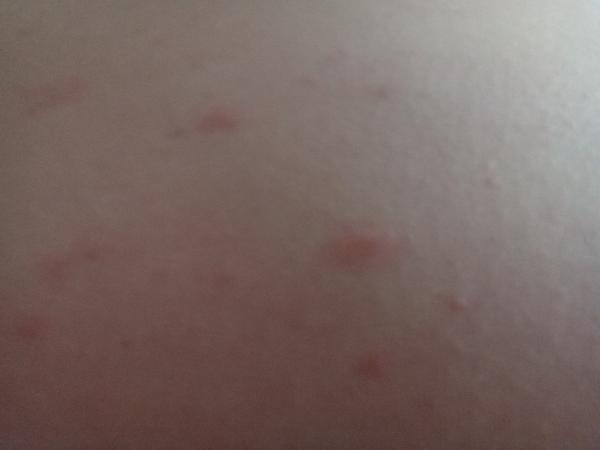 Červené fleky na těle. Může to být reakce na léky?