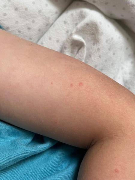 Je vyrážka způsobena krémem nebo potravinami? Diskuze pro maminky