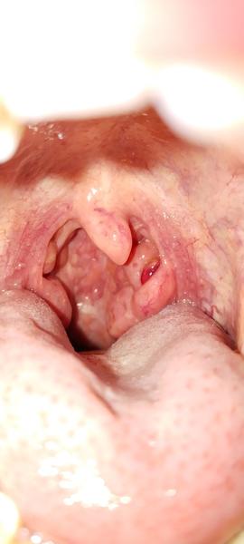 Červená boulička na mandlích. Co způsobuje?