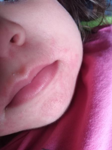 Vyrážka u pusinky po rajčeti. Může to bý alergie?