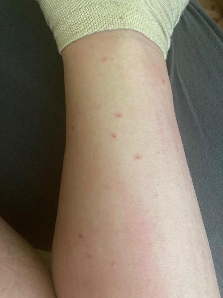 Je svědění nohou během těhotenství příznakem svrabu?