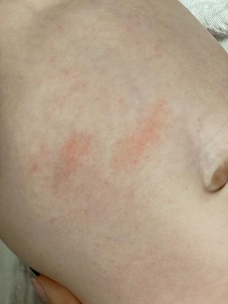 Vyrážka u kojence. Co by to mohlo být a jak se toho zbavit?